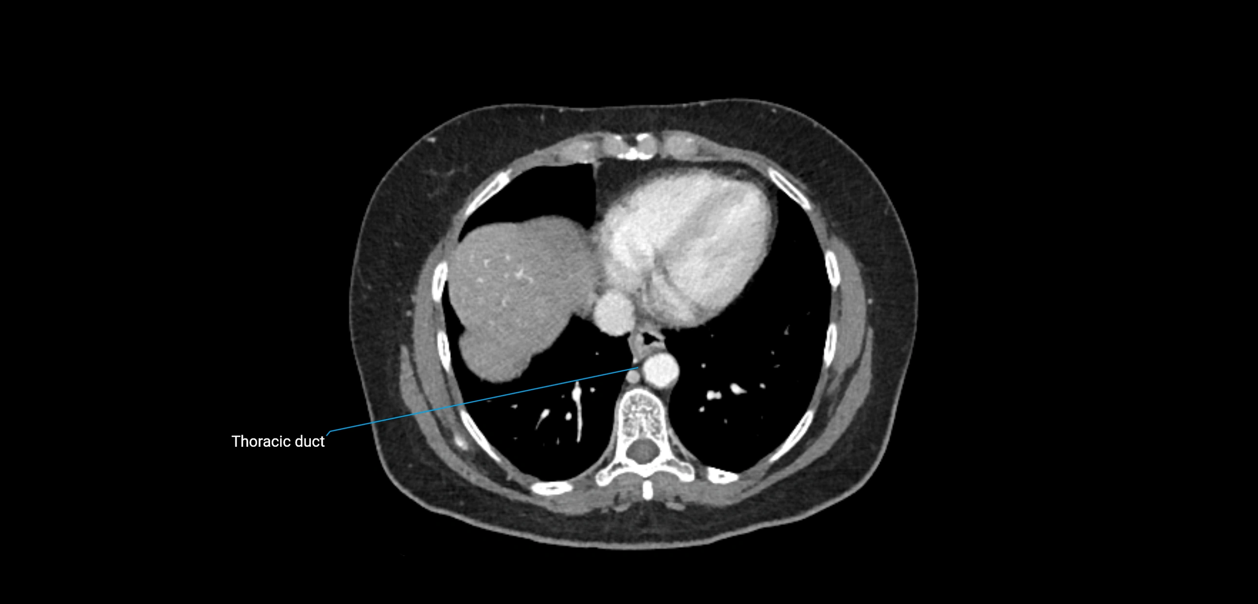 CT ct abdominal lymph nodes  axial cross sectional anatomy  enchanced radiology image -img-00002-00060.webp